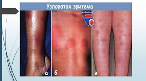 Термин «эритема узловатая» предложил р. Uzlovataya Eritema Prezentaciya Onlajn