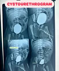 Image result for Voiding Cystourethrogram