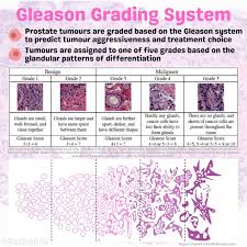 Image result for Prostate Cancer Histologic grading
