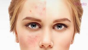 Menyingkirkan sel kulit mati sangat penting untuk mendapatkan kulit wajah yang bersinar dan tampak sehat. Pemilik Kulit Sensitif Berjerawat Cuba 12 Produk Skincare Korea Ini Kesannya Tampak Segera Hijabista