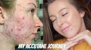 I took 80mg of accutane a day for 5 months and it would continuously get worse, then better off and on for five months. My Isotretinoin Accutane Journey Before And After Photos Youtube