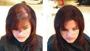 علاج تساقط الشعر تساقط الشعر الاسباب والعلاج أسباب تساقط الشعر علاج تساقط الشعر بالثوم Hair Loss Remedies Women Help Hair Loss Hair Loss Remedies