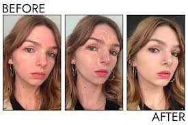 The 10 Best Concealers for Acne of 2025