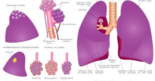 Is collapsed lung symptoms your major concern? Fd5j1hium6s0nm