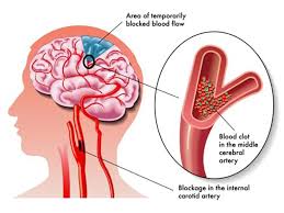 L'emorragia cerebrale (in inglese conosciuta come intracranial hemorrhage, intracranial bleed o ich), corrisponde ad una. Aneurisma Cerebrale Cause Sintomi E Complicanze Assocarenews It Quotidiano Sanitario Nazionale