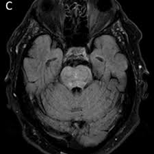 Перевод статьи evans r.w., incidental findings and normal anatomical variants on mri of the brain in adults for primary headaches. Clippers With Brain And Spinal Cord Involvement Eurorad