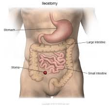 Which set of steps should a empty drainage bag · use the proper equipment for measurement · use standard precautions when. Ostomatology Colostomy Ileostomy Urostomy Nursing Ceu Ceufast