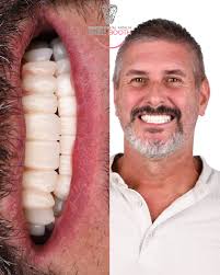 Febe's Smile Transformation ✨ When Febe first visited our clinic, she had  been edentulous for more than 10 years and was relying