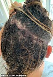 Update your find a dermatologist profile, the academy's directory that's visited by over 1 million people a year. Katie Maxwell Reveals How A Tiny Lump On Her Head Turned Out To Be Skin Cancer Daily Mail Online