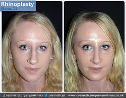 Nose Surgery Patient Case Study Rhinoplasty Cosmetic Surgery