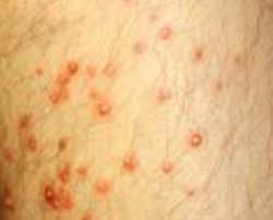While many of the skin. Identifying Bug Bites Pest Control In Ny Nj Pa Ct Pest
