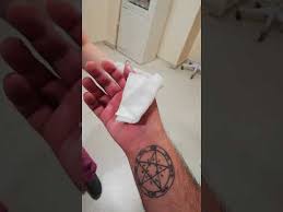 Kirschner Telinin 18cm Elden Cikarilmasi Removing The Medical Kirschner Wire Youtube