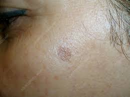 Image result for Solar Lentigo