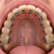 Lingual Braces