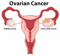 Learn more about ovarian cancer such as what causes it, how it is diagnosed, and available treatment options. The Role Of The Microbiome In Ovarian Cancer Mechanistic Insights Into Oncobiosis And To Bacterial Metabolite Signaling Springerlink