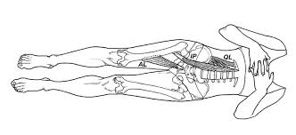 Image result for Functional Leg Length Discrepancy