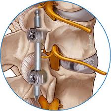 1 woche nach der operation, 6 wochen und 12 wochen nach der durchgeführten operation. Spondylodese Op Wirbelsaulenversteifung Joimax