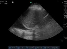 We did not find results for: Pleural Effusion And Mimic Pleural Effusion Ultrasound Sonography Ultrasound