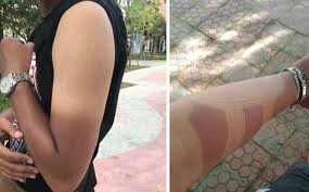 Tea bags for invigorating tired eyes Learn How To Heal A Sunburn From The Inside Out Including 5 Home Remedies Vietnam Times