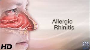 Image result for Allergic Rhinitis