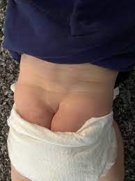 Crooked butt crack. - October 2020 Babies | Forums | What to Expect