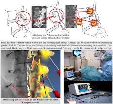 Prof Dr Christian Woiciechowsky Neurochirurgie Berlin Facettendenervation