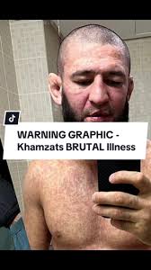 Khamzat Chimaev posted but later deleted pictures of himself showing that  he was very sick 😷 #bestfightclipz #khamzatchimaev #illness #ufc #fy #fyp  #foryoupage #mma #foryou #fighting #wrestler #scary