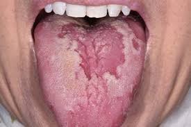 Image result for mouth ulcer on tongue)