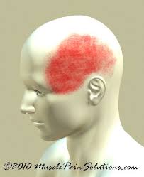 Temple Headache