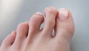 Image result for Pitting nails feet