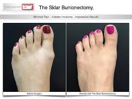 Just A Good Old Fashion Beforeandafter Bunion Pic No Cast Or Crutches Walking The Same Day Visit Www Footfirst For M Podiatry Bunion Plastic Surgery