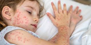 Image result for measles