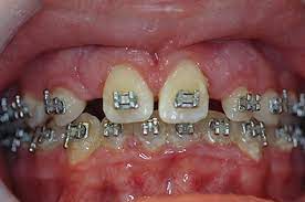 When one wears orthodontic appliances, there are many extra places for plaque to get trapped and build up. Brushing And Flossing Winghaven Orthodontics O Fallon Mo