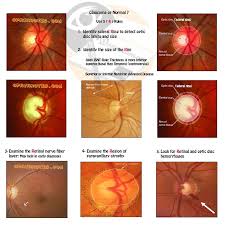 Glaucoma can lead to loss of vision if it's not diagnosed and treated early. Roles Of Glaucomatous Optic Disc Diagnosis Ophthnotes
