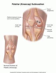 Kneecap Patellar Subluxation Subluxation Knee Exercises Knee Injury