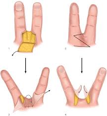 Image result for Syndactyly