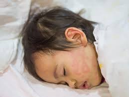 Image result for vyrážka u dětí