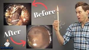 Do Ear Candles Work To Remove Earwax Ear Candling Proof Youtube Ear Candling Ear Wax Ear