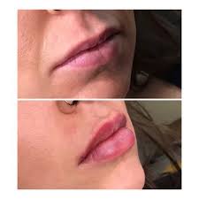 Welcome to illume aesthetics, med spa in ashland, orillume aesthetics offers intimate wellness as well as med spa services including laser treatments, . Illume Aesthetics 33 Photos 16 Reviews Waxing 993 Siskiyou Blvd Ashland Or Phone Number Yelp