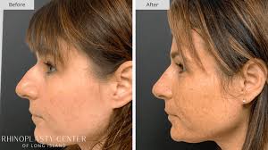 Rhinoplasty Center of Long Island: Premier Nose Job Experts