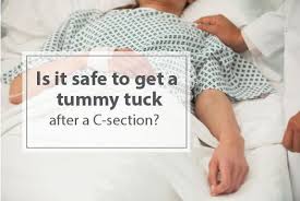 When Can You Have A Tummy Tuck After C Section Tummy Tuck After C Section Tummy Tucks Body Plastic Surgery Best Plastic Surgeons