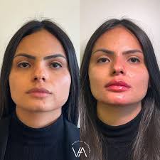 💎 Beleza é poder, e quando você se sente bem, tudo ao seu redor  floresce.🌷 Esse resultado de pós imediato é a prova de que a harmonização  facial não muda quem você