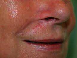 Osterreichische Gesellschaft Fur Dermatochirurgie Ogdc