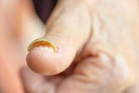 Nagelpilz Erkennen Bilder Typischer Symptome Gesundheit De