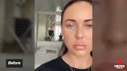 Sydney teenager Dakota Stephenson treated in ICU for EVALI, a lung  condition linked to vaping