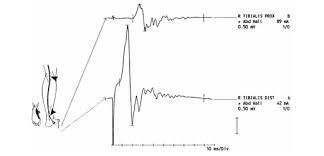 We did not find results for: Diagnose Und Differentialdiagnose Guillain Barre Syndrom Quellenhof Wildbad Sana Kliniken Ag