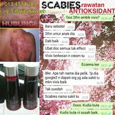 Kurangkan rasa gatal dan miang kudis buta ini pada kanak. Ini Cara Saya Merawat Kudis Buta Dengan Cepat