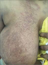 Image result for Inflammatory breast cancer