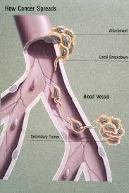 Colorectal cancer starts with a tumor in your colon or rectum. Metastasis Wikipedia
