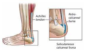 Achillespeesklachten Achillodynie Ontsteking Of Irritatie Van De Achillespees Of De Slijmbeurs Podotherapie Eemland